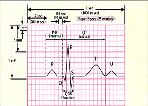 bazzet|QT Interval • LITFL • ECG Library Basics